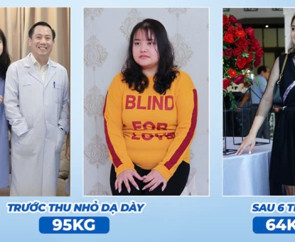 Tốc độ giảm cân sau phẫu thuật nội soi thu nhỏ dạ dày như thế nào?